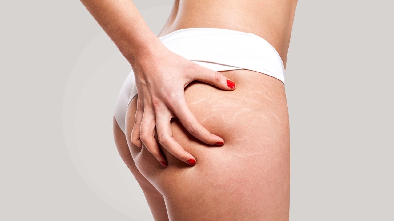 Zabiegi na cellulit Gdańsk- kiedy wybrać?